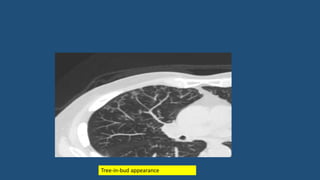 Tree-in-bud appearance
 