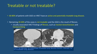 Treatable or not treatable?
• 60-80% of patients with GGO on HRCT have an active and potentially treatable lung disease.
• Remaining 20-40% of the cases is not treatable and the GGO is the result of fibrosis.
• Usually associated HRCT findings of fibrosis, such as traction bronchiectasis and
honeycombing.
 