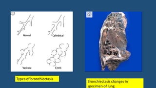 Types of bronchiectasis
Bronchiectasis changes in
specimen of lung
 
