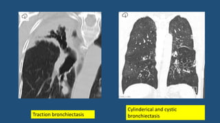 Traction bronchiectasis
Cylinderical and cystic
bronchiectasis
 