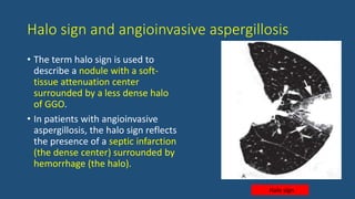 Halo sign and angioinvasive aspergillosis
• The term halo sign is used to
describe a nodule with a soft-
tissue attenuation center
surrounded by a less dense halo
of GGO.
• In patients with angioinvasive
aspergillosis, the halo sign reflects
the presence of a septic infarction
(the dense center) surrounded by
hemorrhage (the halo).
Halo sign
 