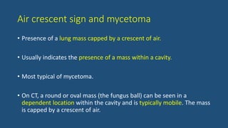 Air crescent sign and mycetoma
• Presence of a lung mass capped by a crescent of air.
• Usually indicates the presence of a mass within a cavity.
• Most typical of mycetoma.
• On CT, a round or oval mass (the fungus ball) can be seen in a
dependent location within the cavity and is typically mobile. The mass
is capped by a crescent of air.
 
