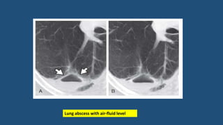 Lung abscess with air-fluid level
 