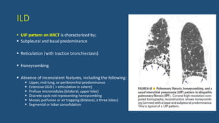 ILD
• UIP pattern on HRCT is characterized by:
 Subpleural and basal predominance
 Reticulation (with traction bronchiectasis)
 Honeycombing
 Absence of inconsistent features, including the following:
 Upper, mid-lung, or peribronchial predominance
 Extensive GGO ( > reticulation in extent)
 Profuse micronodules (bilateral, upper lobe)
 Discrete cysts not representing honeycombing
 Mosaic perfusion or air trapping (bilateral, ≥ three lobes)
 Segmental or lobar consolidation
 