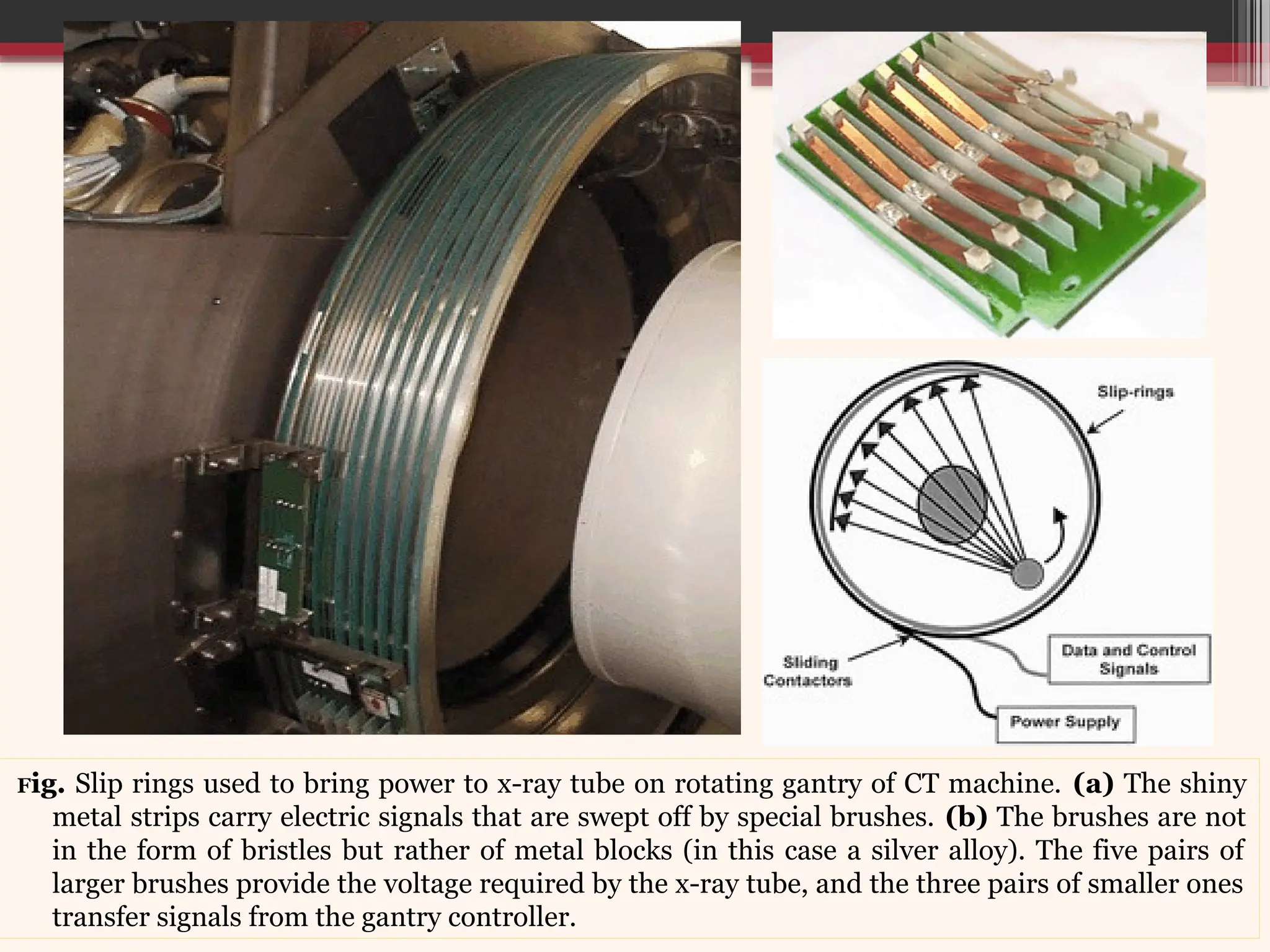 Fig. Slip rings used to bring power to x-ray tube on rotating gantry of CT machine. (a) The shiny
metal strips carry electric signals that are swept off by special brushes. (b) The brushes are not
in the form of bristles but rather of metal blocks (in this case a silver alloy). The five pairs of
larger brushes provide the voltage required by the x-ray tube, and the three pairs of smaller ones
transfer signals from the gantry controller.
 