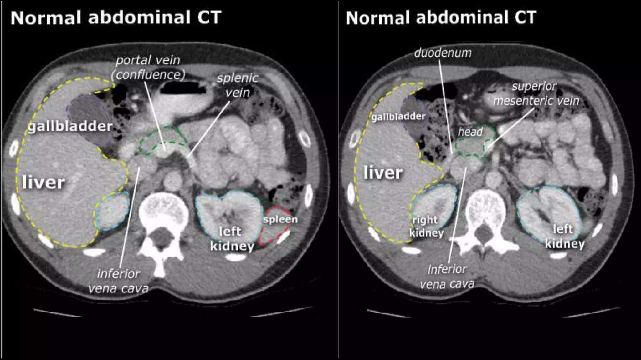 CT liver segments ANATOMY BIPHASI TRIPHASIC | PPTX