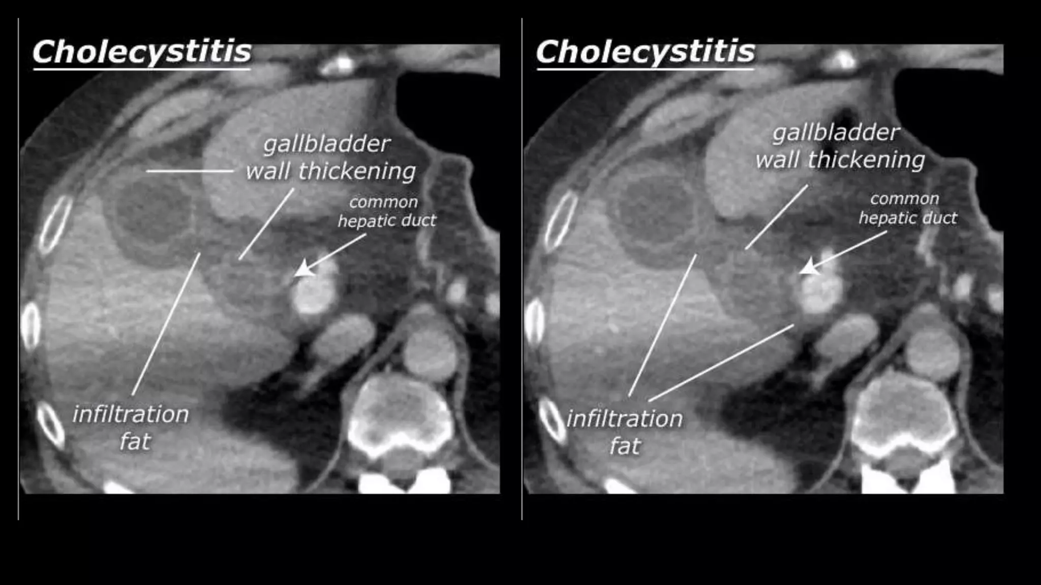 Liver segments Radiopaedia.com1
