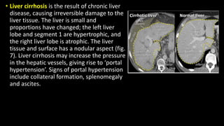 • Liver cirrhosis is the result of chronic liver
disease, causing irreversible damage to the
liver tissue. The liver is small and
proportions have changed; the left liver
lobe and segment 1 are hypertrophic, and
the right liver lobe is atrophic. The liver
tissue and surface has a nodular aspect (fig.
7). Liver cirrhosis may increase the pressure
in the hepatic vessels, giving rise to ‘portal
hypertension’. Signs of portal hypertension
include collateral formation, splenomegaly
and ascites.
 