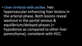 • Liver cirrhosis with ascites. Two
hypervascular enhancing liver lesions in
the arterial phase. Both lesions reveal
washout in the portal venous &
equilibrium/delayed phases (=
hypodense as compared to other liver
parenchyma), consistent with HCC.
 