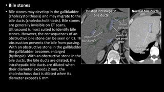 • Bile stones
• Bile stones may develop in the gallbladder
(cholecystolithiasis) and may migrate to the
bile ducts (choledocholithiasis). Bile stones
are generally invisible on CT scans.
Ultrasound is most suited to identify bile
stones. However, the consequences of an
obstructive bile stone can be seen on CT. The
obstruction prevents the bile from passing.
With an obstructive stone in the gallbladder,
the gallbladder becomes enlarged
(hydropic). With an obstructive stone in the
bile ducts, the bile ducts are dilated; the
intrahepatic bile ducts are dilated when
their diameter exceeds 2 mm, the
choledochous duct is dilated when its
diameter exceeds 6 mm
 
