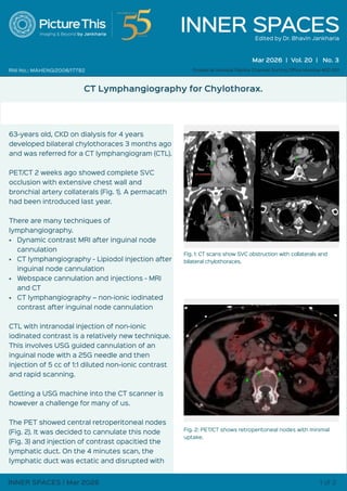 CT Lymphangiography for Diagnosing and Managing Chylothorax in SVC ...