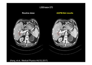 Routine dose AAPM-Net results
(Kang, et al, Medical Physics 44(10) 2017)
 