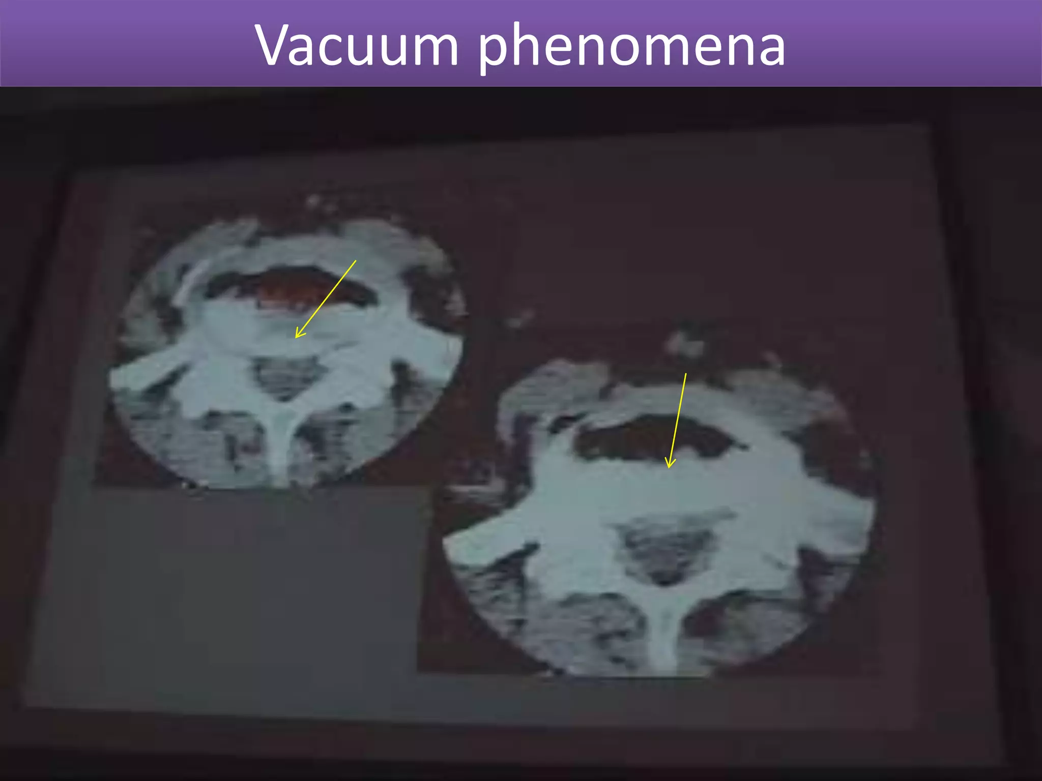 MRI – LUMBAR SPINEMNERVE ROOTSFORAMENAXIAL VIEW