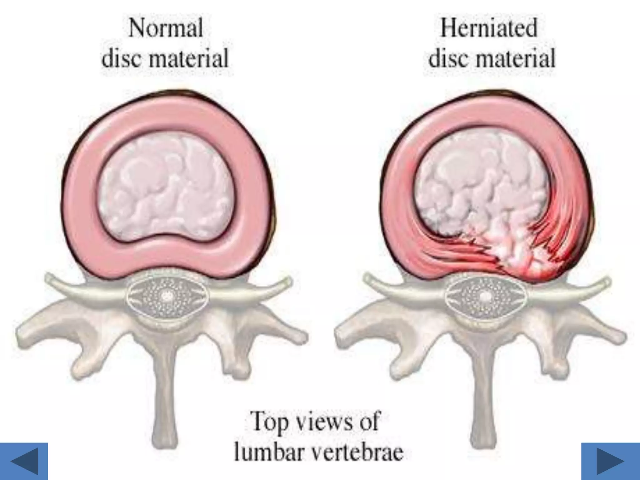 Difference between cervical & lumbar spine in CT 