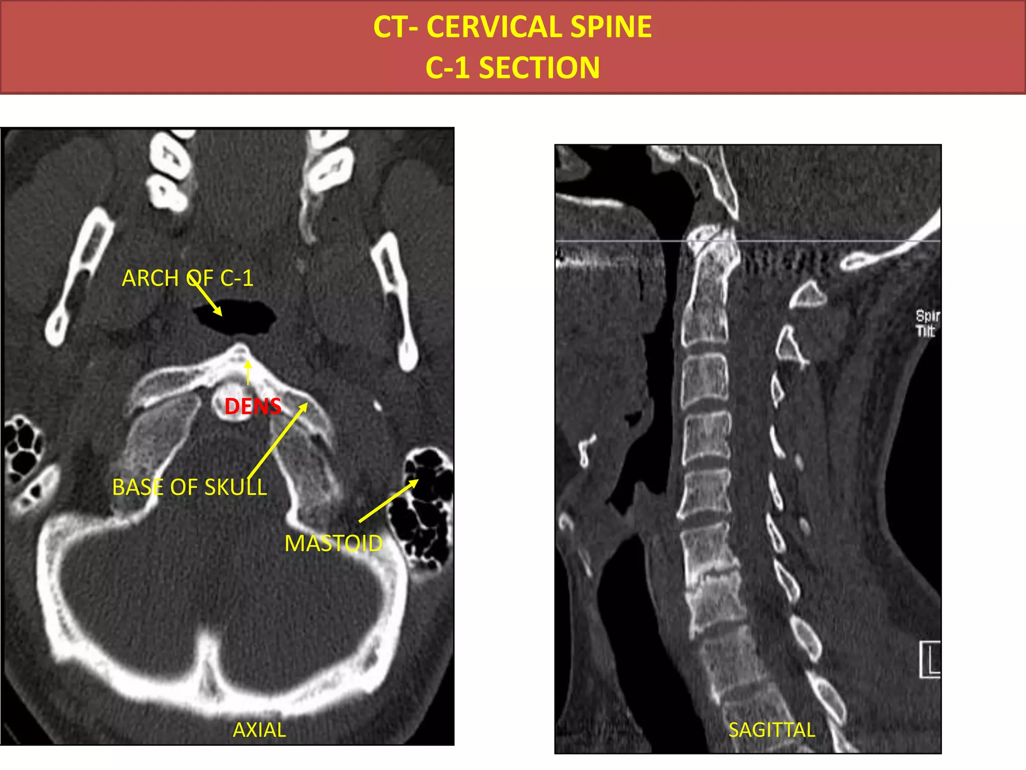 MRI                   CT           plain x-Ray 