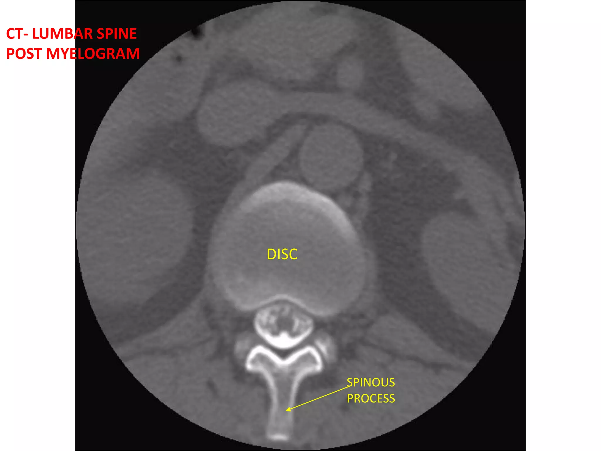 CT– CERVICAL SPINEC2-3 INTERVERTEBRAL DISC FORAMENDISCFORAMENFACET JOINTFACET JOINTSPINOUS PROCESSAXIALSAGITTAL