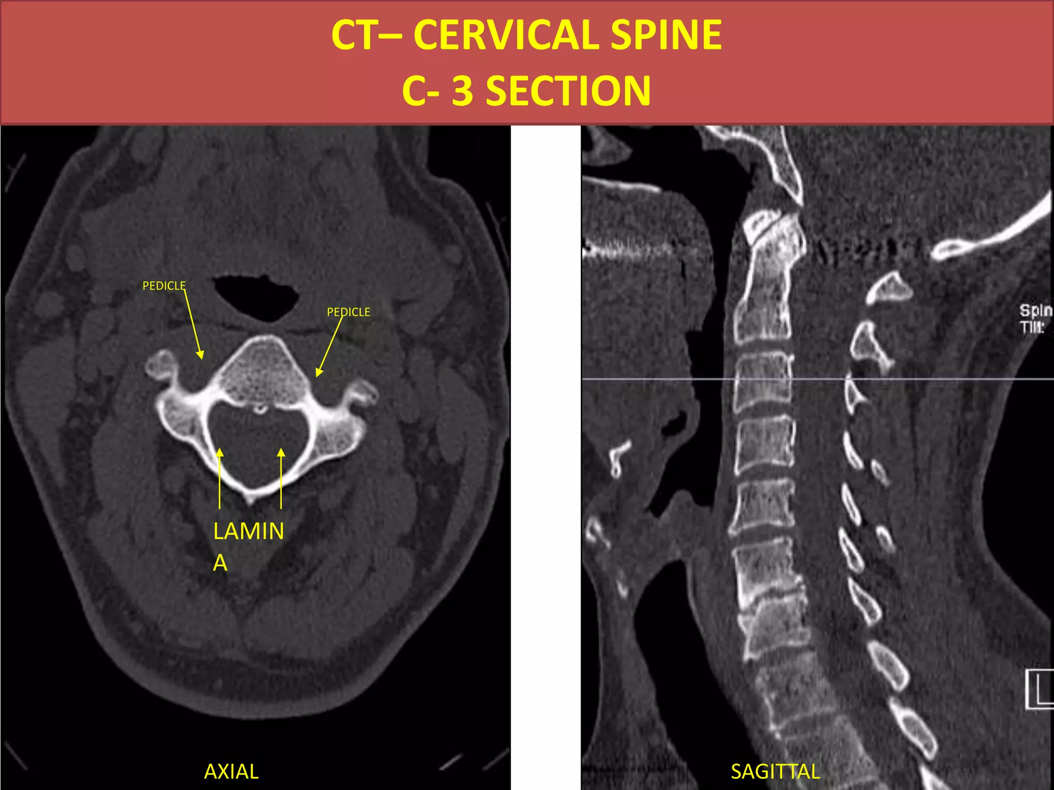 CT- CERVICAL SPINEC-1 SECTIONARCH OF C-1DENSBASE OF SKULLMASTOIDAXIALSAGITTAL