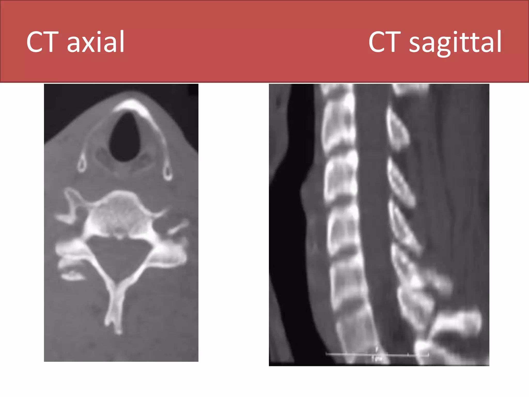 CT– CERVICAL SPINEC- 3 SECTIONPEDICLEPEDICLELAMINAAXIALSAGITTAL
