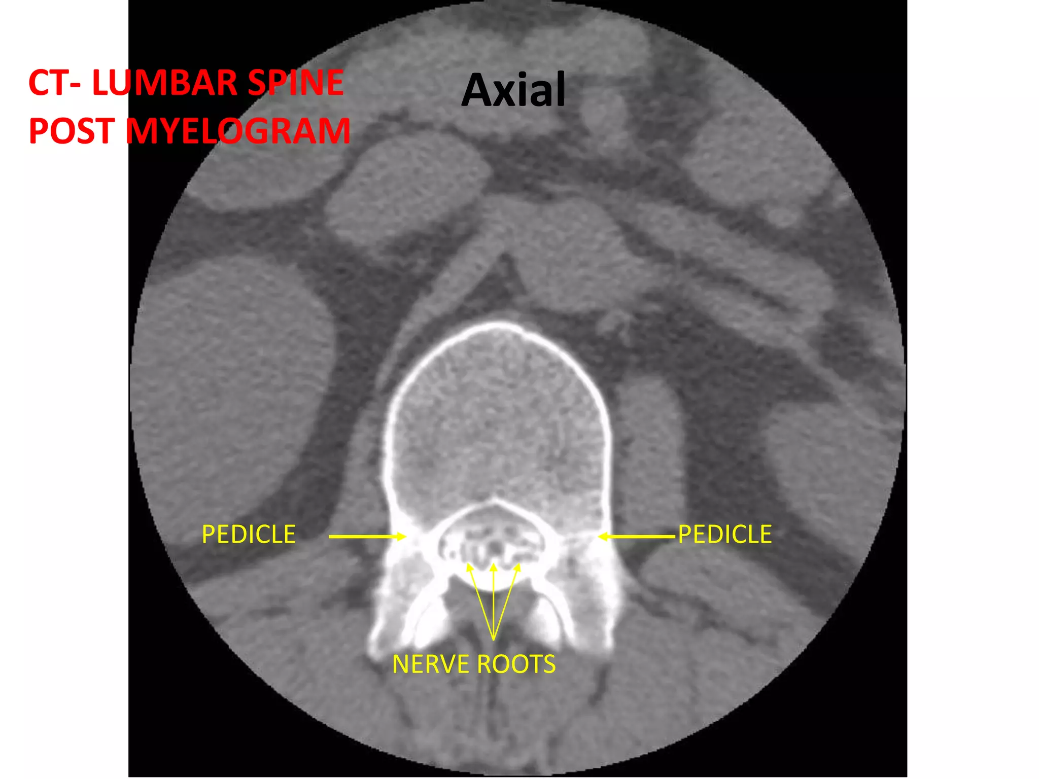 CT-- CERVICAL SPINEC-2 SECTIONC-2 BODYDEGENERATEDC6-7C-2 SPINOUS PROCESSAXIALSAGITTAL
