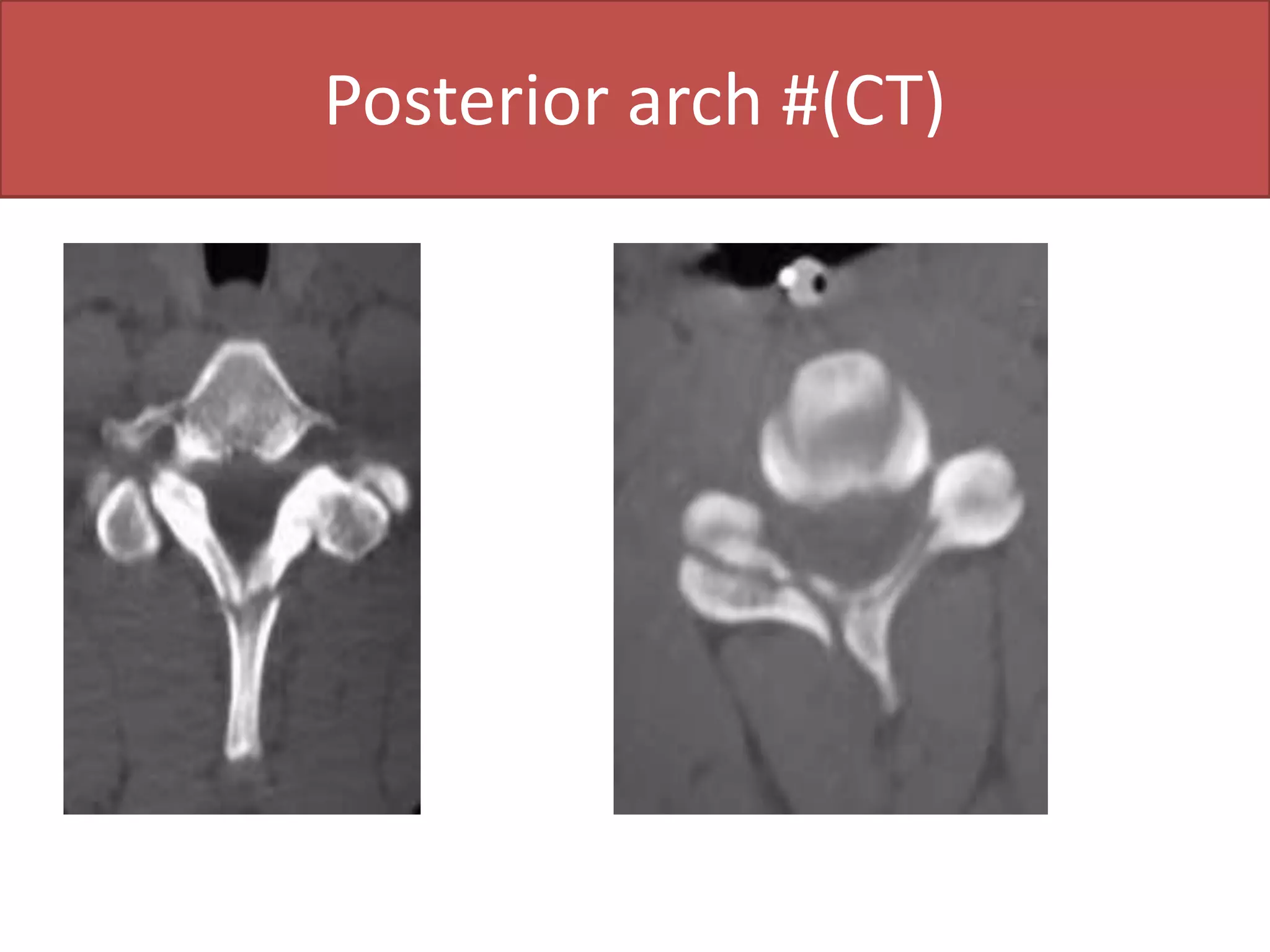 CT axial                                 CT sagittal  