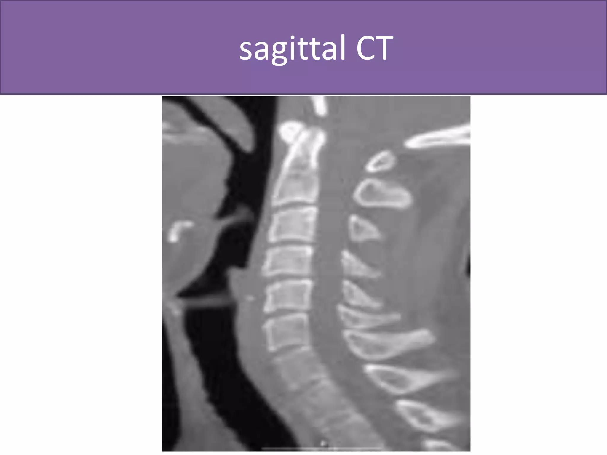 Posterior arch #(CT)