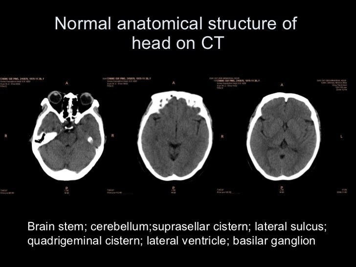 Ct & mri of central nervous system