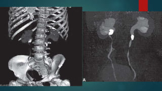 Ct mri urography | PPTX
