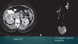 Ct mri urography | PPTX