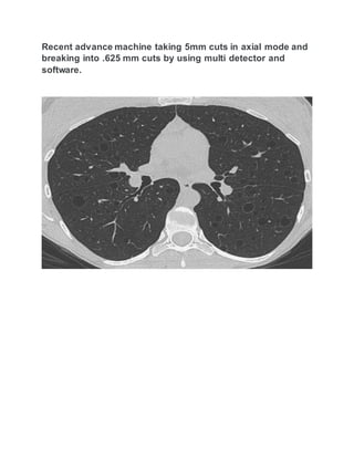 Recent advance machine taking 5mm cuts in axial mode and
breaking into .625 mm cuts by using multi detector and
software.
 