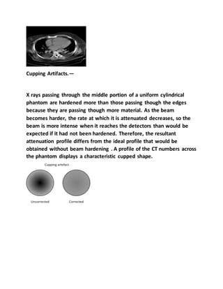 Cupping Artifacts.—
X rays passing through the middle portion of a uniform cylindrical
phantom are hardened more than those passing though the edges
because they are passing though more material. As the beam
becomes harder, the rate at which it is attenuated decreases, so the
beam is more intense when it reaches the detectors than would be
expected if it had not been hardened. Therefore, the resultant
attenuation profile differs from the ideal profile that would be
obtained without beam hardening . A profile of the CT numbers across
the phantom displays a characteristic cupped shape.
 