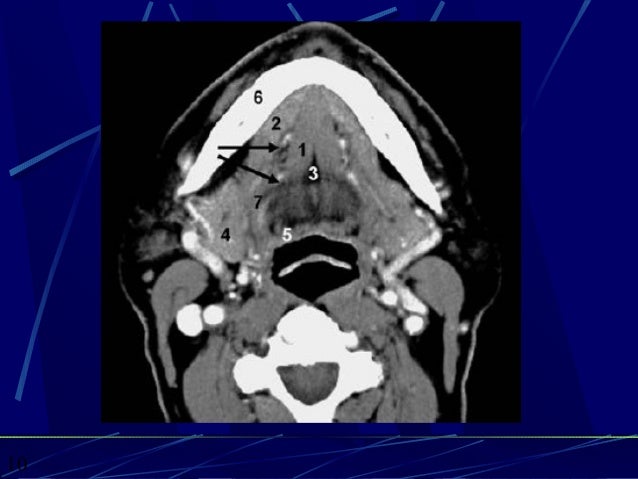 CT ANATOMY OF THE NECK SPACES