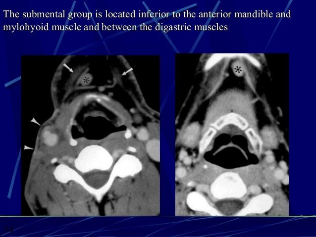 CT ANATOMY OF THE NECK SPACES