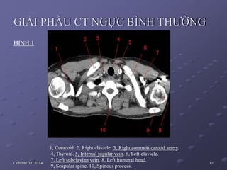 GIẢI PHẪU CT NGỰC BÌNH THƯỜNG
HÌNH 1
October 31, 2014
1, Coracoid. 2, Right clavicle. 3, Right common carotid artery.
4, Thyroid. 5, Internal jugular vein. 6, Left clavicle.
7, Left subclavian vein. 8, Left humeral head.
9, Scapular spine. 10, Spinous process.
12
 
