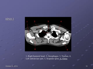 HÌNH 2
1, Right humeral head. 2, Oesophagus. 3, Trachea. 4,
Left subclavian vein. 5, Scapular spine. 6, Glena
October 31, 2014 13
 