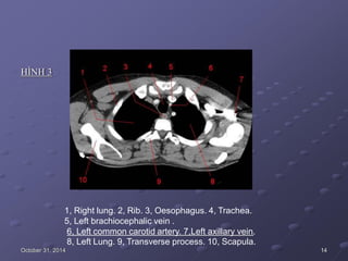 HÌNH 3
1, Right lung. 2, Rib. 3, Oesophagus. 4, Trachea.
5, Left brachiocephalic vein .
6, Left common carotid artery. 7,Left axillary vein.
8, Left Lung. 9, Transverse process. 10, Scapula.
October 31, 2014 14
 