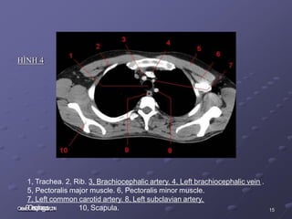 HÌNH 4
1, Trachea. 2, Rib. 3, Brachiocephalic artery. 4, Left brachiocephalic vein .
5, Pectoralis major muscle. 6, Pectoralis minor muscle.
7, Left common carotid artery. 8, Left subclavian artery,
O
c
t
o
b
e
r
9
O
e
s
o
p
h
a
g
u
s
.
3
1
,2
0
1
4 10, Scapula. 15
 
