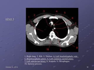 HÌNH 5
1, Right lung. 2, Rib. 3, Trachea. 4, Left brachiocephalic vein .
5, Brachiocephalic artery. 6, Left common carotid artery.
7, Left subclavian artery. 8, Scapula. 9, Oesophagus.
10, Spinous process.
October 31, 2014 16
 