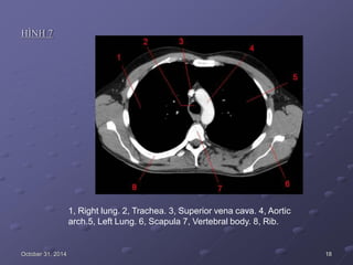 HÌNH 7
1, Right lung. 2, Trachea. 3, Superior vena cava. 4, Aortic
arch.5, Left Lung. 6, Scapula 7, Vertebral body. 8, Rib.
October 31, 2014 18
 