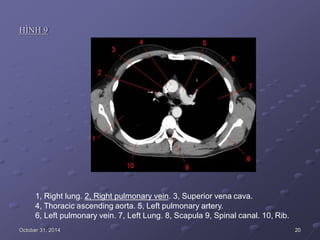 HÌNH 9
1, Right lung. 2, Right pulmonary vein. 3, Superior vena cava.
4, Thoracic ascending aorta. 5, Left pulmonary artery.
6, Left pulmonary vein. 7, Left Lung. 8, Scapula 9, Spinal canal. 10, Rib.
October 31, 2014 20
 