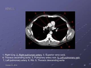HÌNH 11
1, Right lung. 2, Right pulmonary artery. 3, Superior vena cava.
4, Thoracic ascending aorta. 5, Pulmonary artery root. 6, Left pulmonary vein.
7, Left pulmonary artery. 8, Rib. 9, Thoracic descending aorta
October 31, 2014 22
 