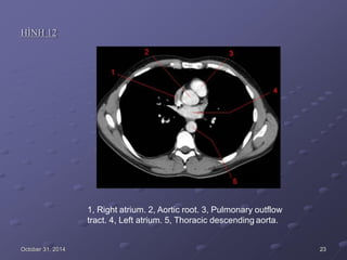HÌNH 12
1, Right atrium. 2, Aortic root. 3, Pulmonary outflow
tract. 4, Left atrium. 5, Thoracic descending aorta.
October 31, 2014 23
 