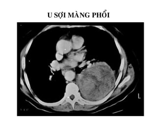 U SÔÏI MAØNG PHOÅI
 