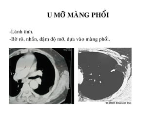 U MÔÕ MAØNG PHOÅI
-Laønh tính.
-Bôø roõ, nhaün, ñaäm ñoä môõ, döïa vaøo maøng phoåi.
 