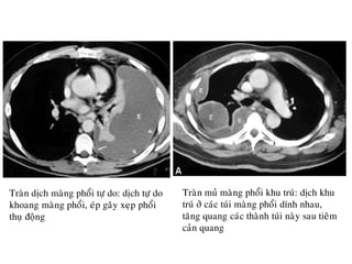 Traøn dòch maøng phoåi töï do: dòch töï do
khoang maøng phoåi, eùp gaây xeïp phoåi
thuï ñoäng
Traøn muû maøng phoåi khu truù: dòch khu
truù ôû caùc tuùi maøng phoåi dính nhau,
taêng quang caùc thaønh tuùi naøy sau tieâm
caûn quang
 