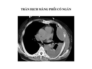 TRAØN DÒCH MAØNG PHOÅI COÙ NGAÊN
 