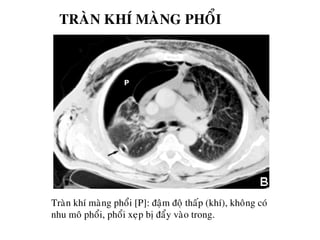 TRAØN KHÍ MAØNG PHOÅI
Traøn khí maøng phoåi [P]: ñaäm ñoä thaáp (khí), khoâng coù
nhu moâ phoåi, phoåi xeïp bò ñaåy vaøo trong.
 