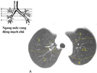 Ngang möùc cung
ñoäng maïch chuû
3
3
2
1/2
1
6
 