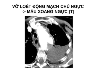 VỠ LOÉT ĐỘNG MẠCH CHỦ NGỰC
-> MÁU XOANG NGỰC (T)
 