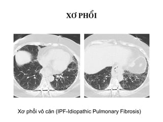 XÔ PHOÅI
Xơ phổi vô căn (IPF-Idiopathic Pulmonary Fibrosis)
 