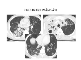 TREE-IN-BUB (MAÀM CAÂY)
 